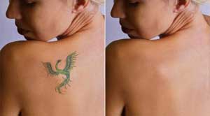 Remoção de Tatuagem Antes e Depois